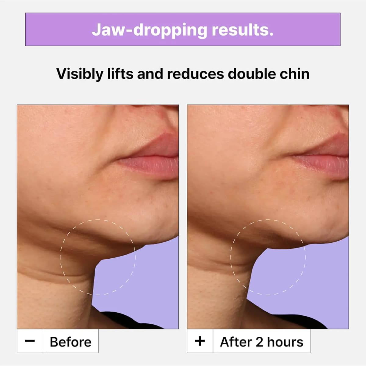 Before and after close-up of a chin showing reduced double chin after 2 hours of mask use.