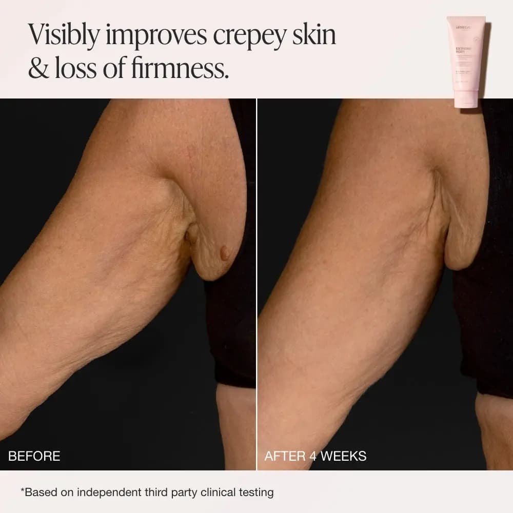 Before and after 4 weeks comparison of an upper arm showing less crepey, sagging skin against a black background
