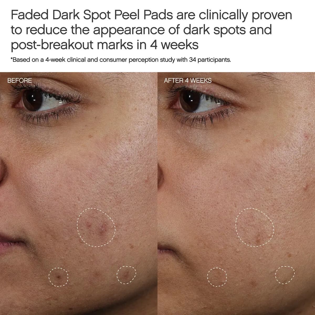 Before and after 4 weeks close-up of a cheek with circled dark spots fading after using the Faded peel pads