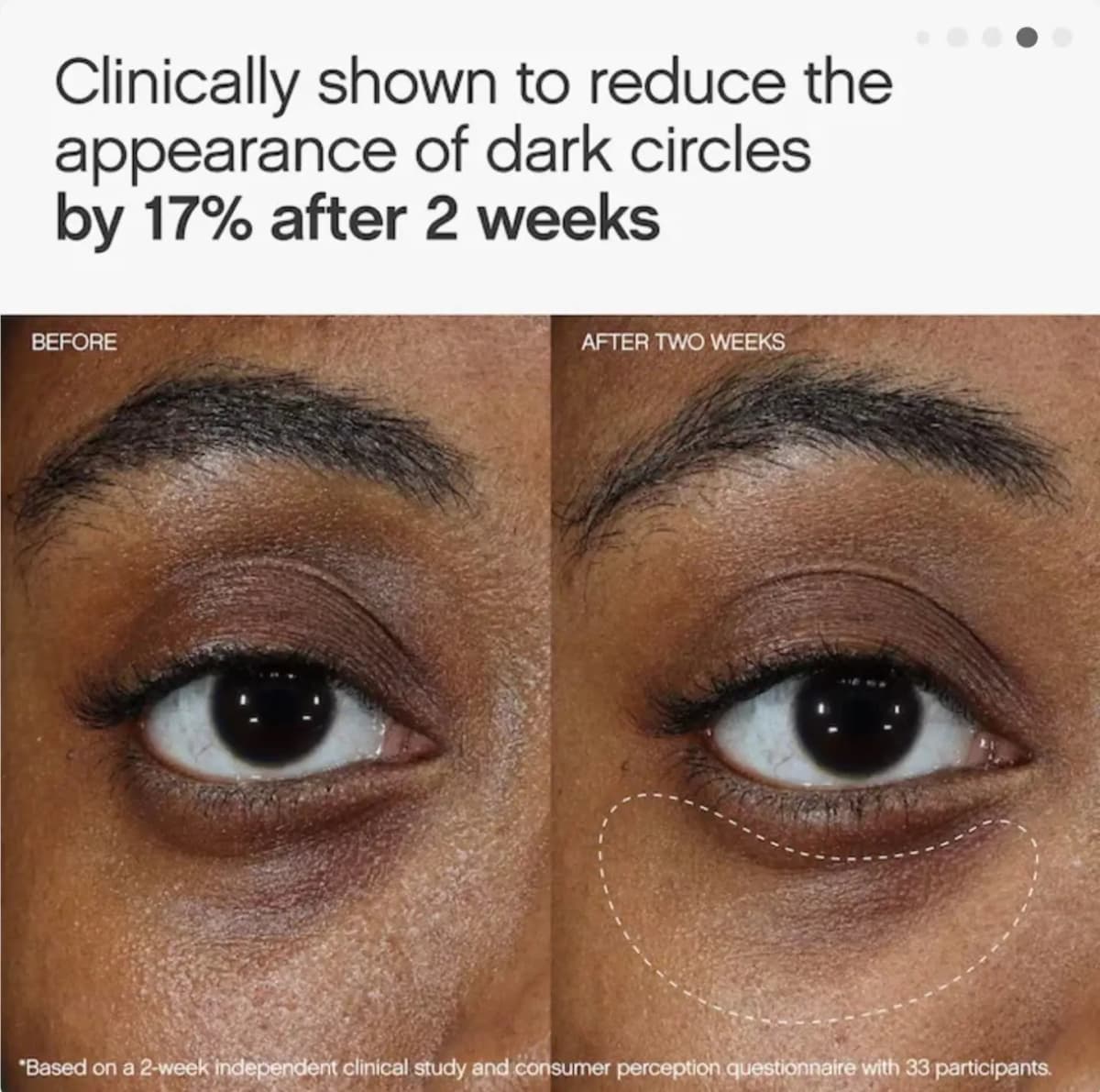 Before and after-two-weeks under-eye close-up claiming a 17% reduction in the appearance of dark circles
