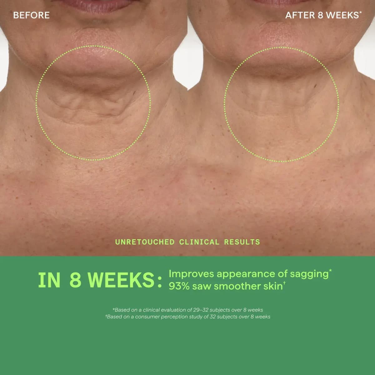 Before and after 8 weeks neck close-up showing less sagging, with green banner citing unretouched clinical results