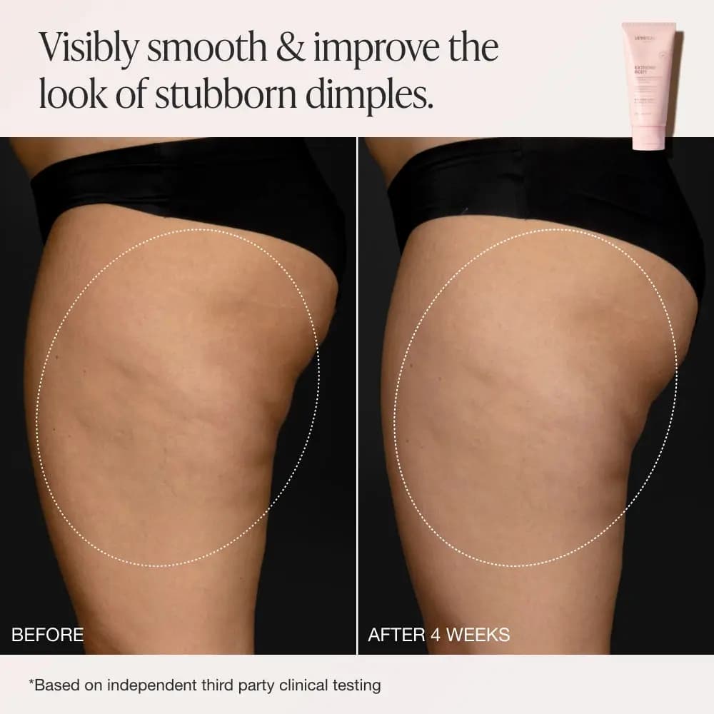 Before and after 4 weeks side view of a thigh and buttock with a dotted circle highlighting smoother dimpled skin