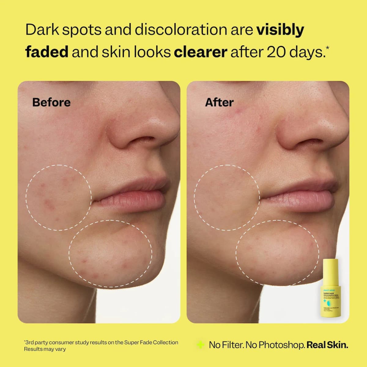 Before and after close-ups of a cheek and chin with fewer dark spots, Super Fade serum bottle shown, on yellow