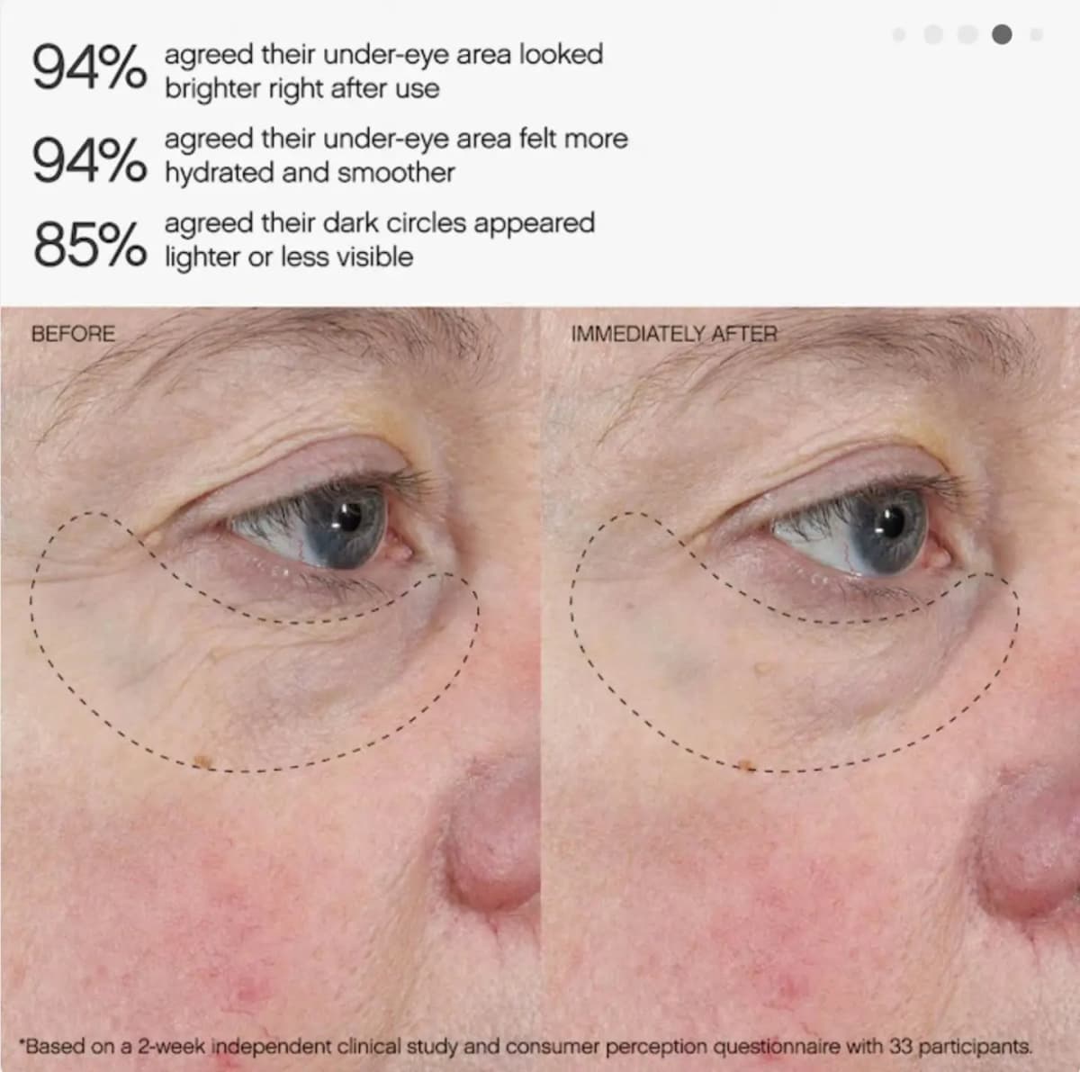 Before and immediately-after close-up of an under-eye area with 94% and 85% consumer survey results
