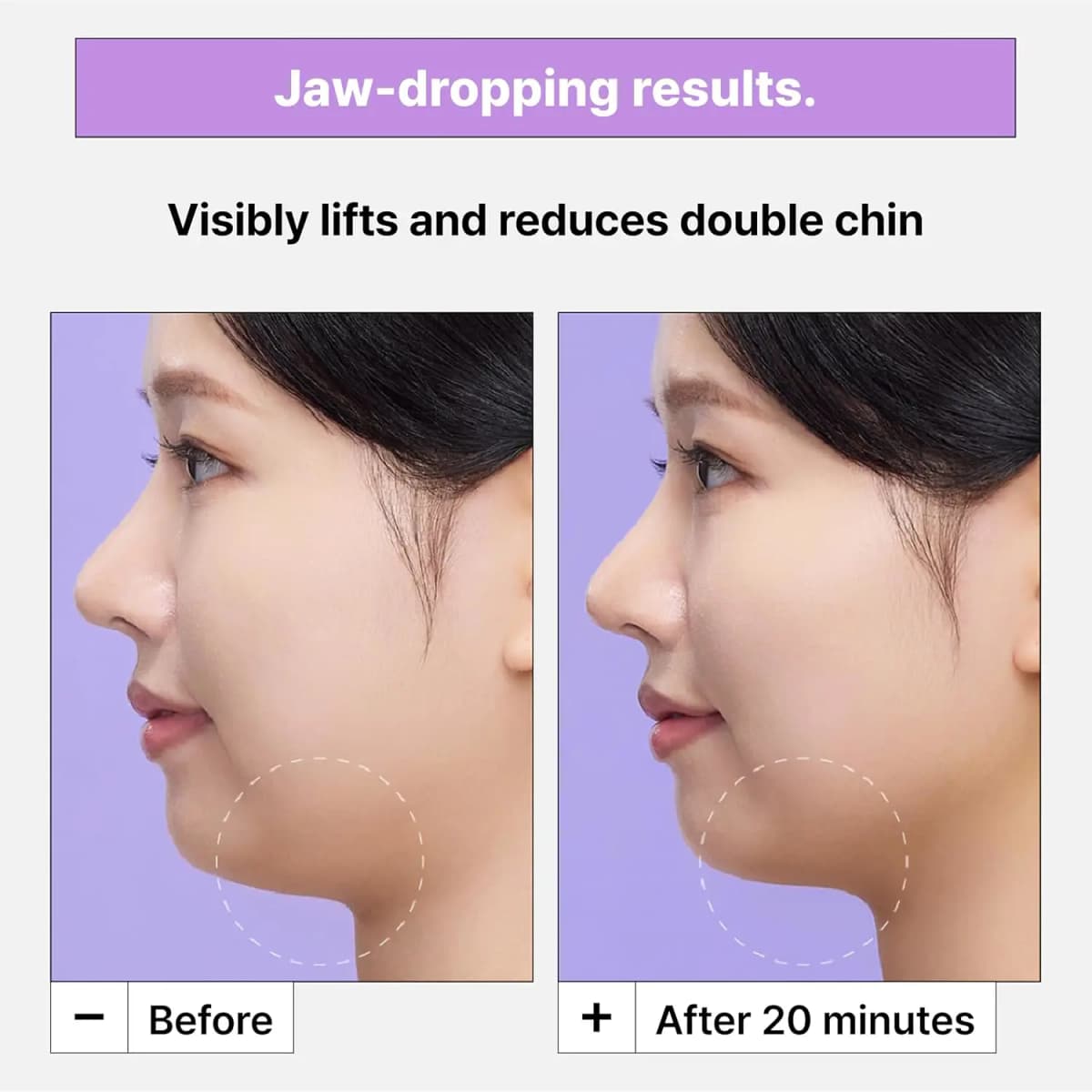 Side profile before and after comparison showing a more defined jawline after 20 minutes.