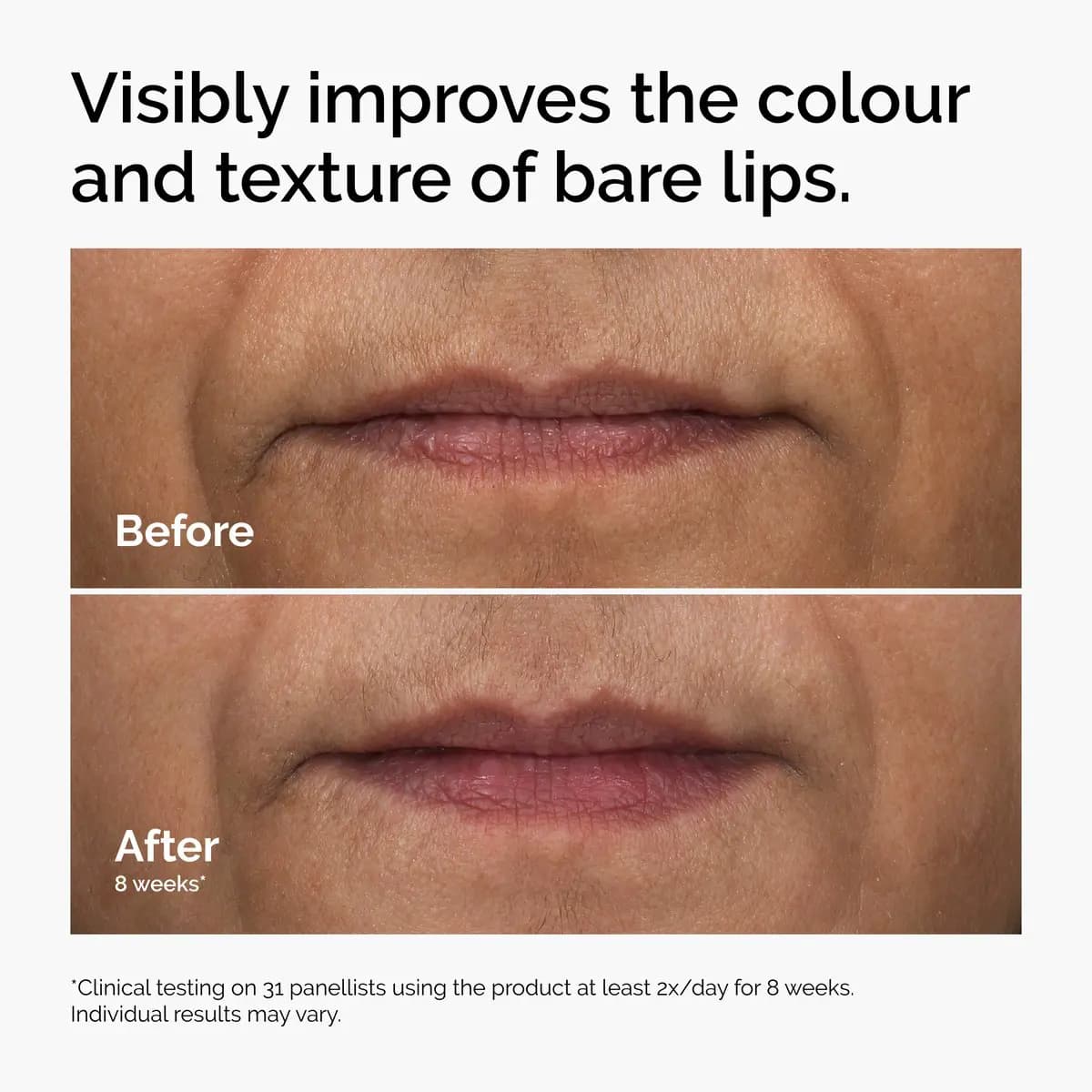 Before and after of bare lips showing more even rosy colour and smoother texture after eight weeks